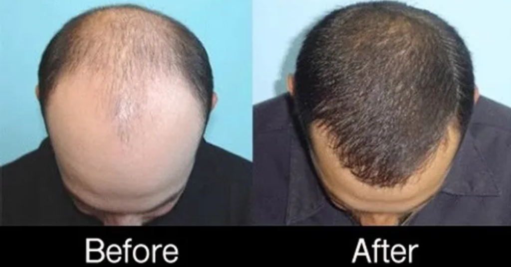 POST HAIR - TRANSPLANT PRP TREATMENT