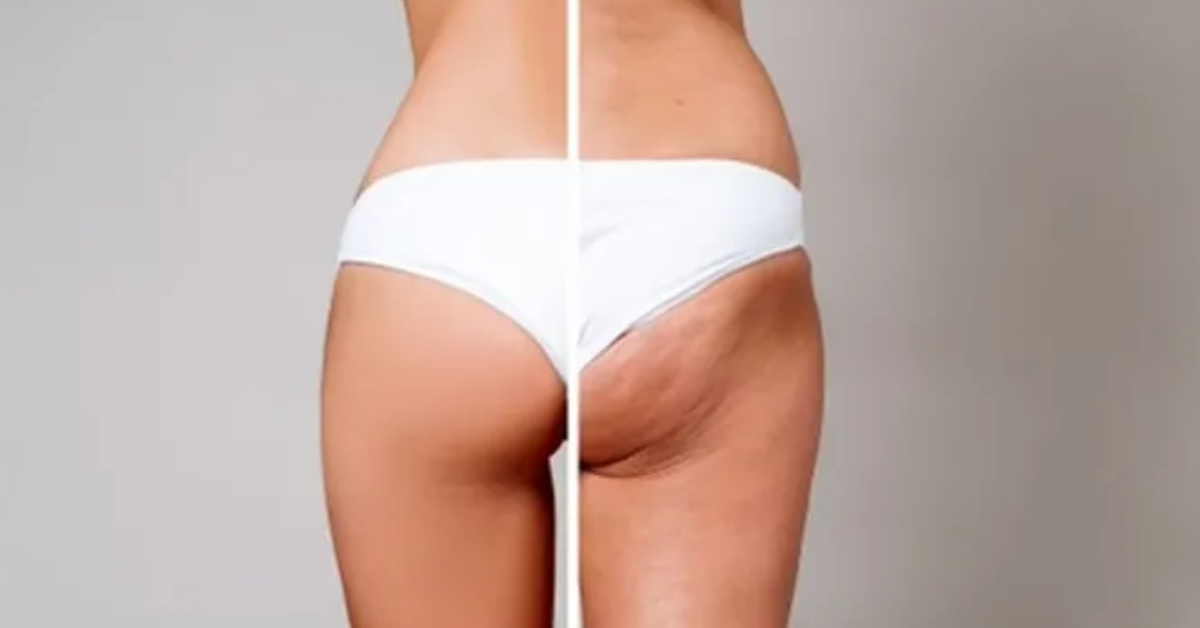 Treatment of cellulite with PRP (platelet rich plasma)