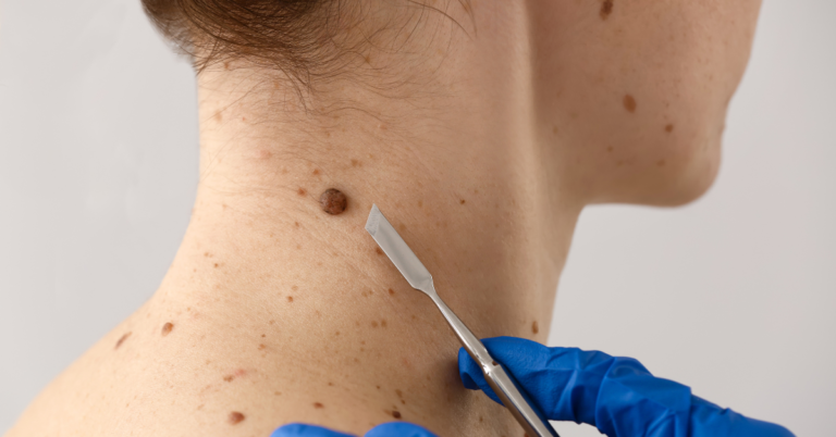 How Does Mole Removal Work at Astrum Medical?