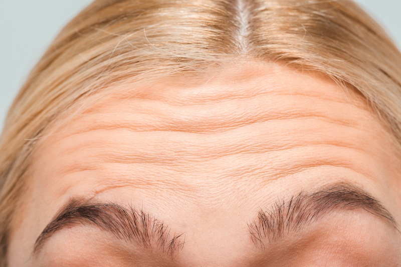 woman scrunching forehead wrinkle fillers concept photo