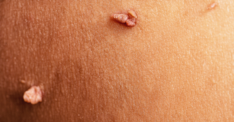 How Effective Is Skin Tag Removal? What You Need to Know