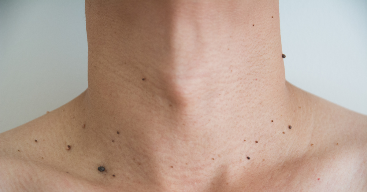 What Are the Best Methods for Skin Tag Removal?