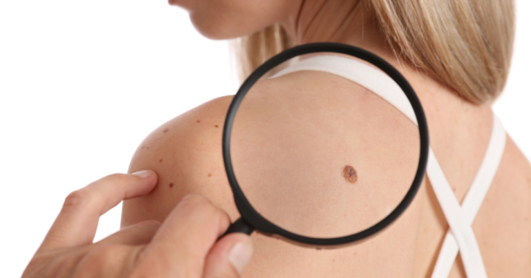 How Safe Is Skin Tag Removal and What Are the Best Methods?