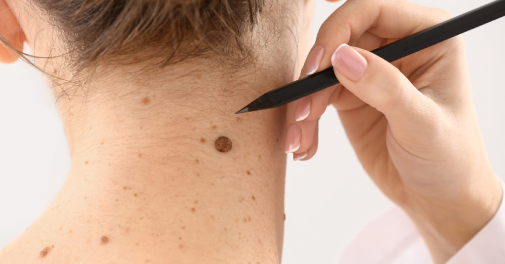 What Should You Expect During and After Mole Removal?