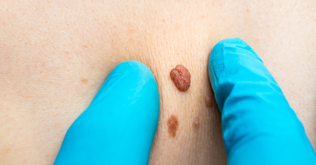 Are Skin Tags Harmful, and When Should You Consider Removal?