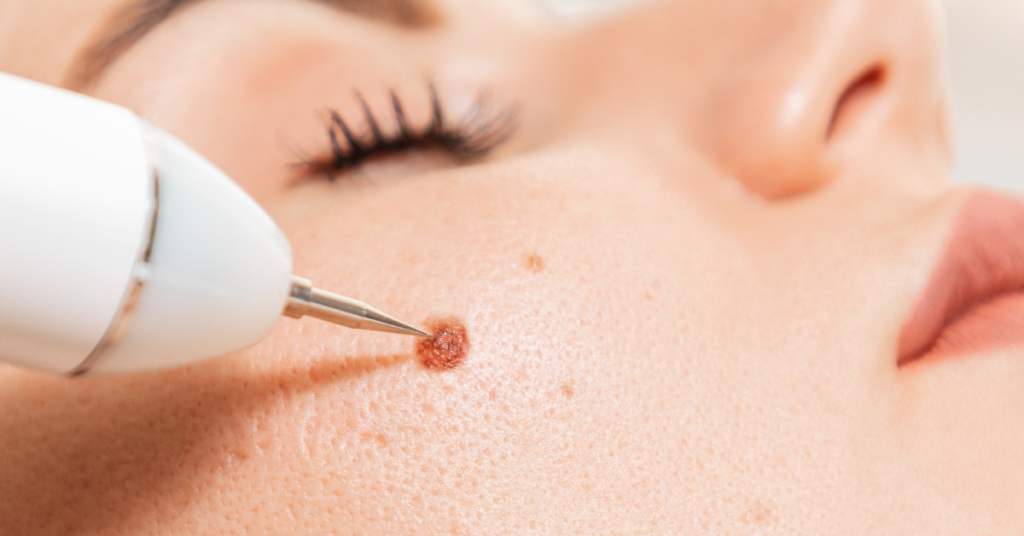 When Is the Right Time to Remove a Skin Tag or Mole?