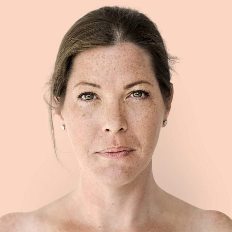 Tranexamic Acid Mesotherapy for Pigmentation: Melasma Treatment